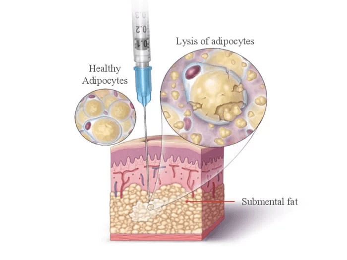 What Is Deoxycholic Acid Injection and How Is It Used in Aesthetic Clinics?