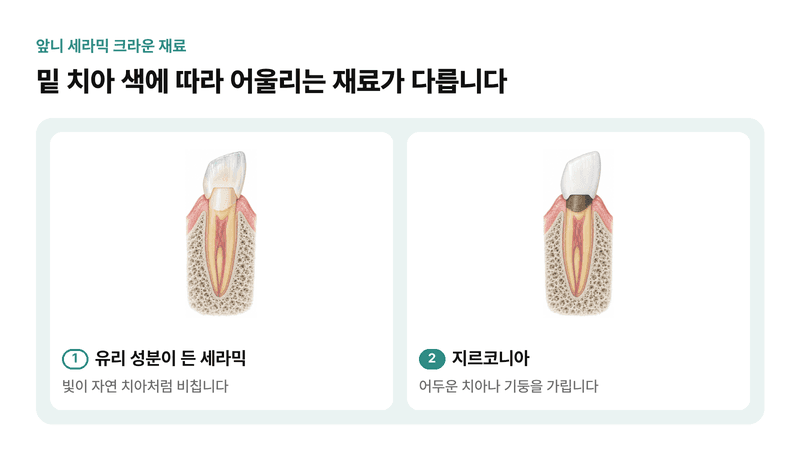 어둡게 변한 앞니 위에 씌운 유리 성분 세라믹 크라운과 지르코니아 크라운이 빛을 통과시키고 어두운 색을 가리는 정도를 비교한 일러스트