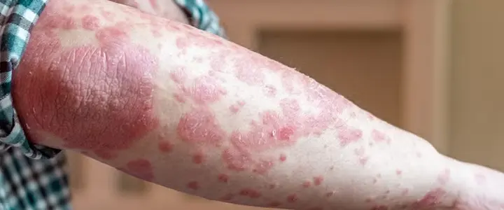Dry, itchy red patches in elbow/knee folds or on neck/face