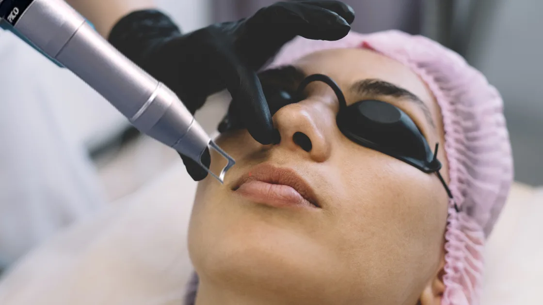 A technical shot showing a Q-Switched laser or a chemical peel being applied precisely to the lip borders.