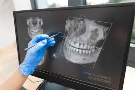 3D imaging for dental implants
