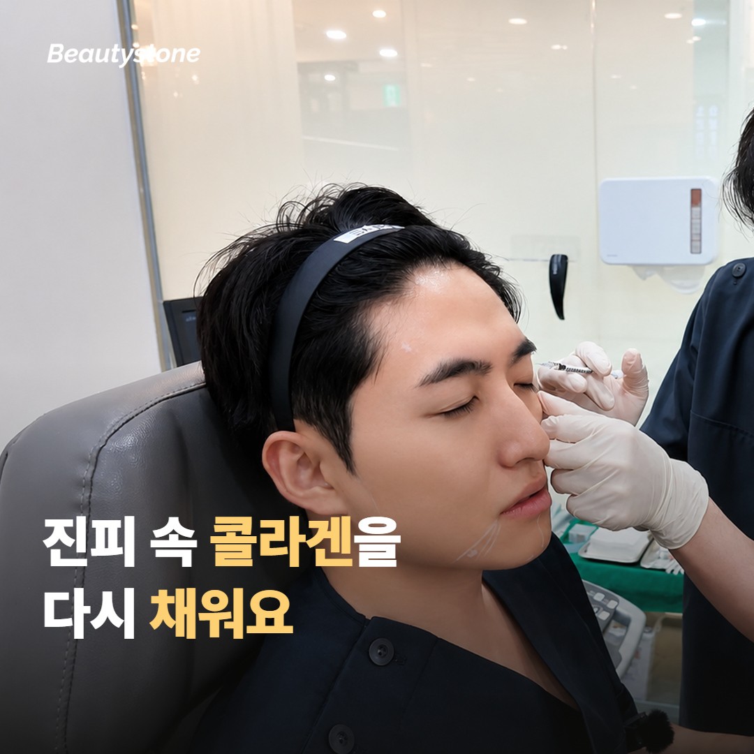 포텐자 마이크로니들 RF가 진피에 작동하는 원리