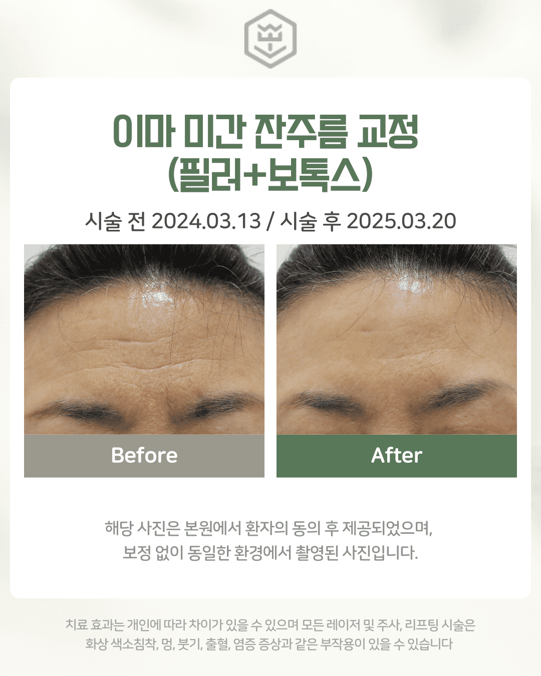 이마 미간 잔주름 교정 (필러+보톡스)