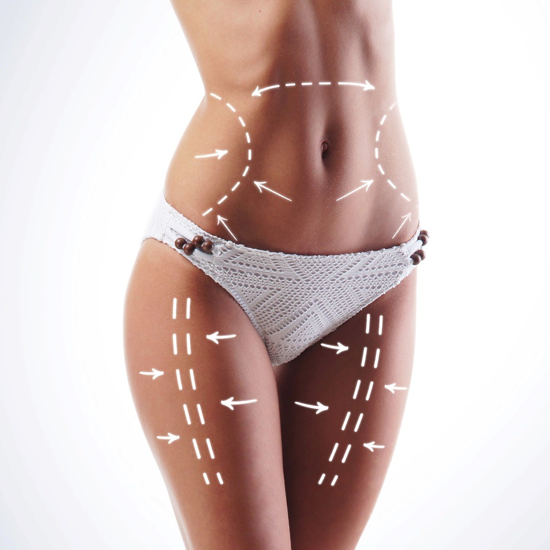 liposuction