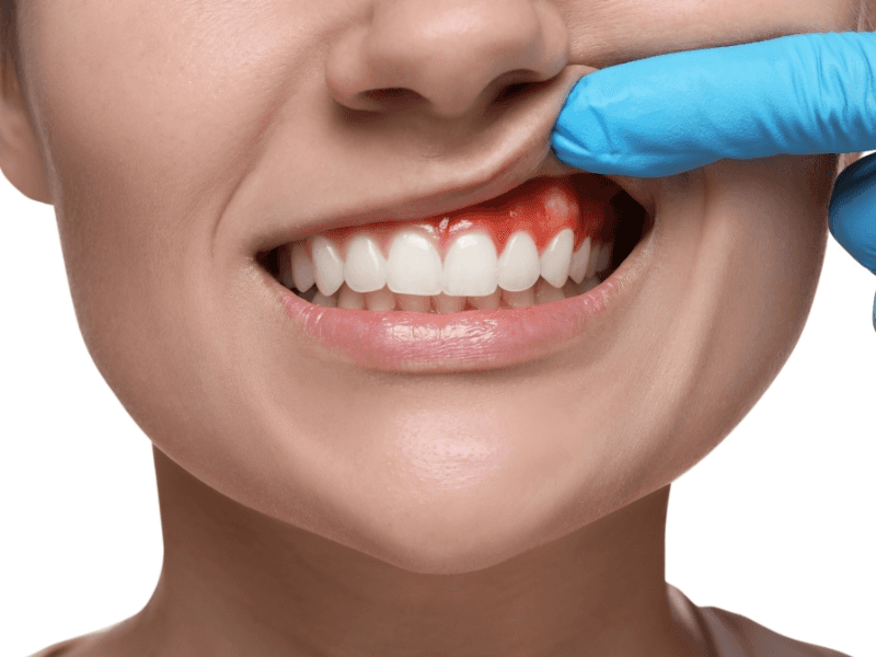 Poor oral hygiene habits