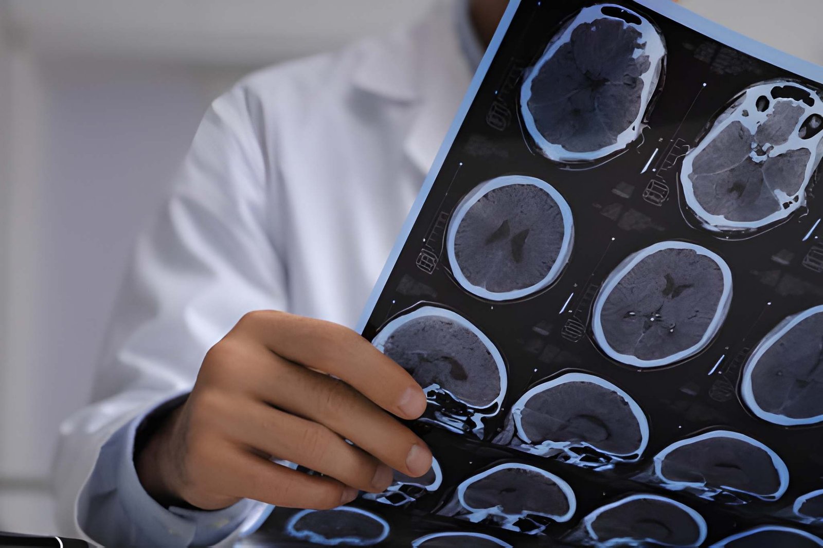 post concussion syndrome settlement value