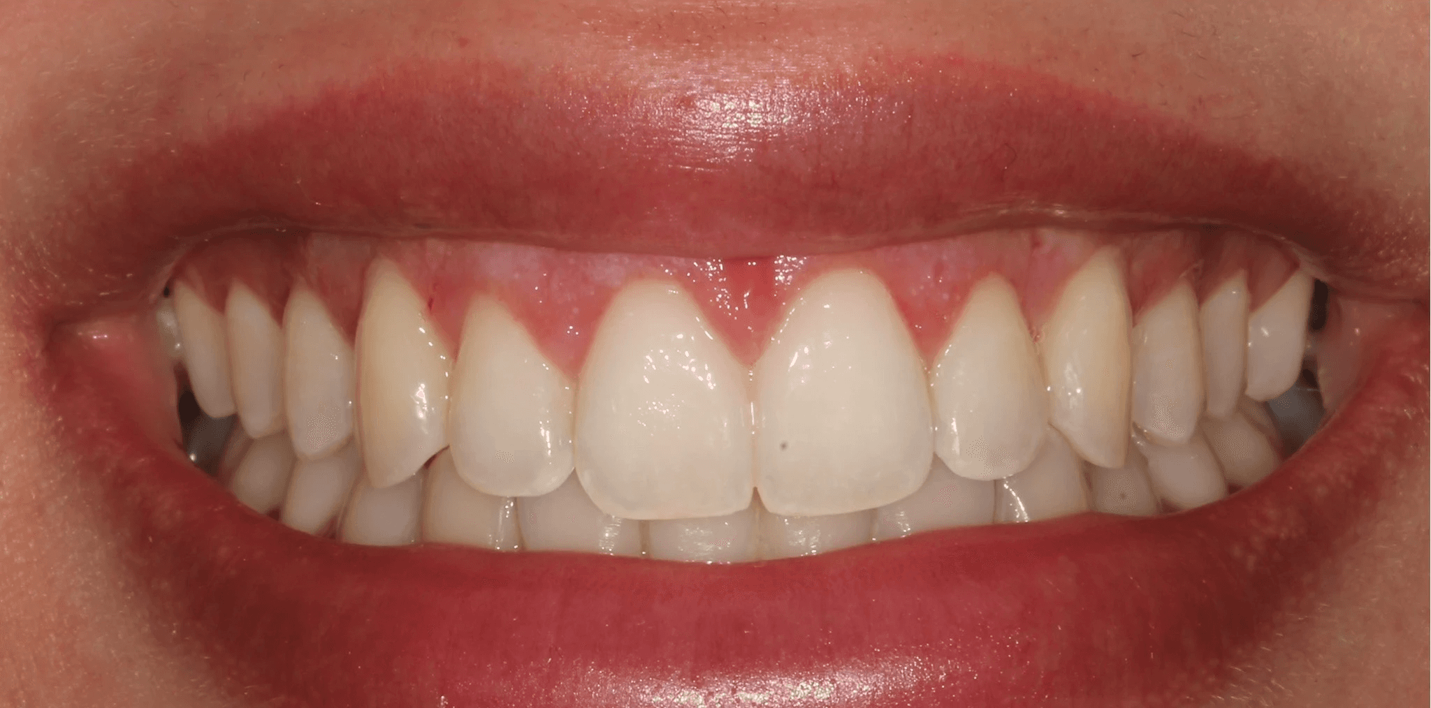 After treatment of gummy smile and uneven gingival margin at Bloor-Yorkville Periodontics. Teeth look symetrical and cosmetically restored.