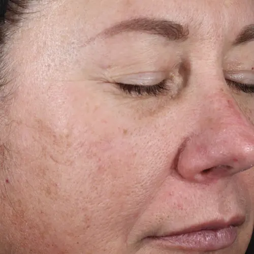 After antioxidant treatment at The Vancouver Aesthetician — skin visibly lifted, pigmentation faded, complexion noticeably brighter and more radiant