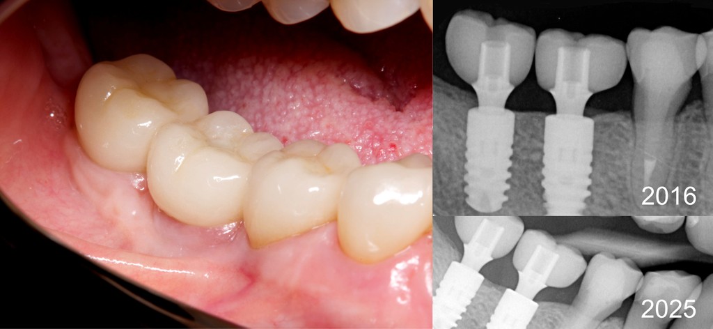 Foto keramických koruniek zadných zubov na implantátoch
