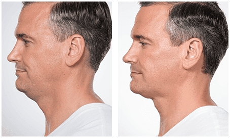 Before and after Kybella, side profile showing less fullness under the chin