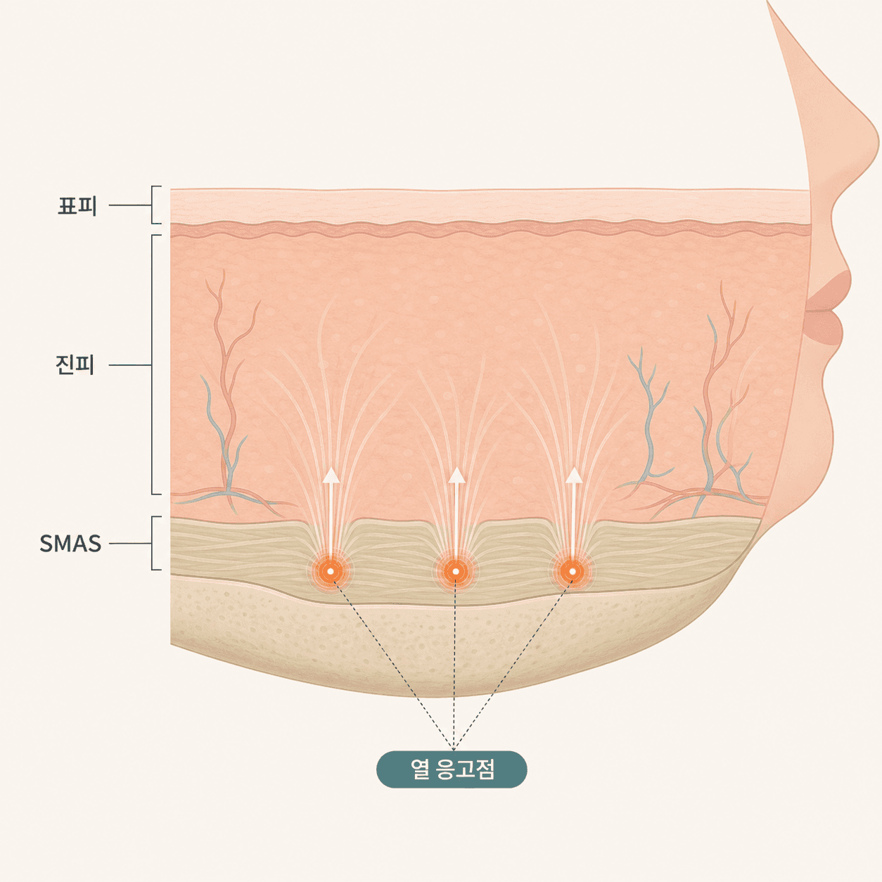 표피를 보존한 채 진피와 깊은 SMAS 층까지 나눠 작용하는 슈링크 유니버스의 열 응고점