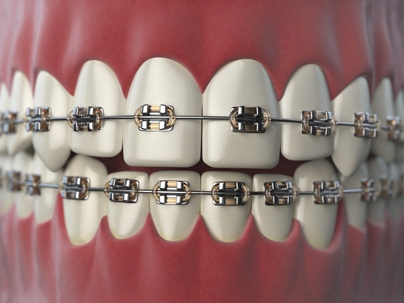 Smiling person with braces and brown hair