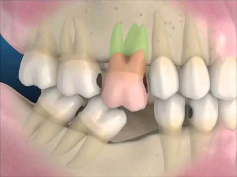 Fogászati implantátum (műgyökér beültetés)