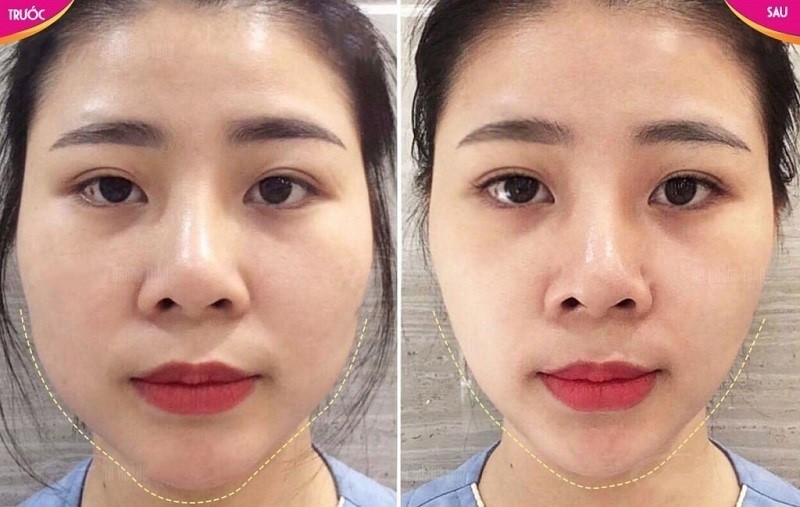 Sự thay đổi rõ rệt giữa trước và sau khi tiêm botox gọn hàm