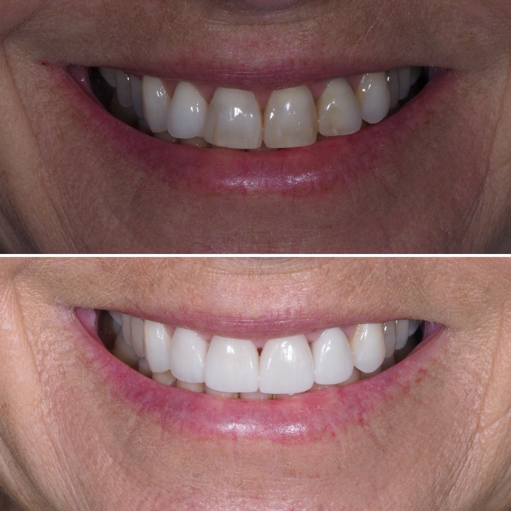Before & After