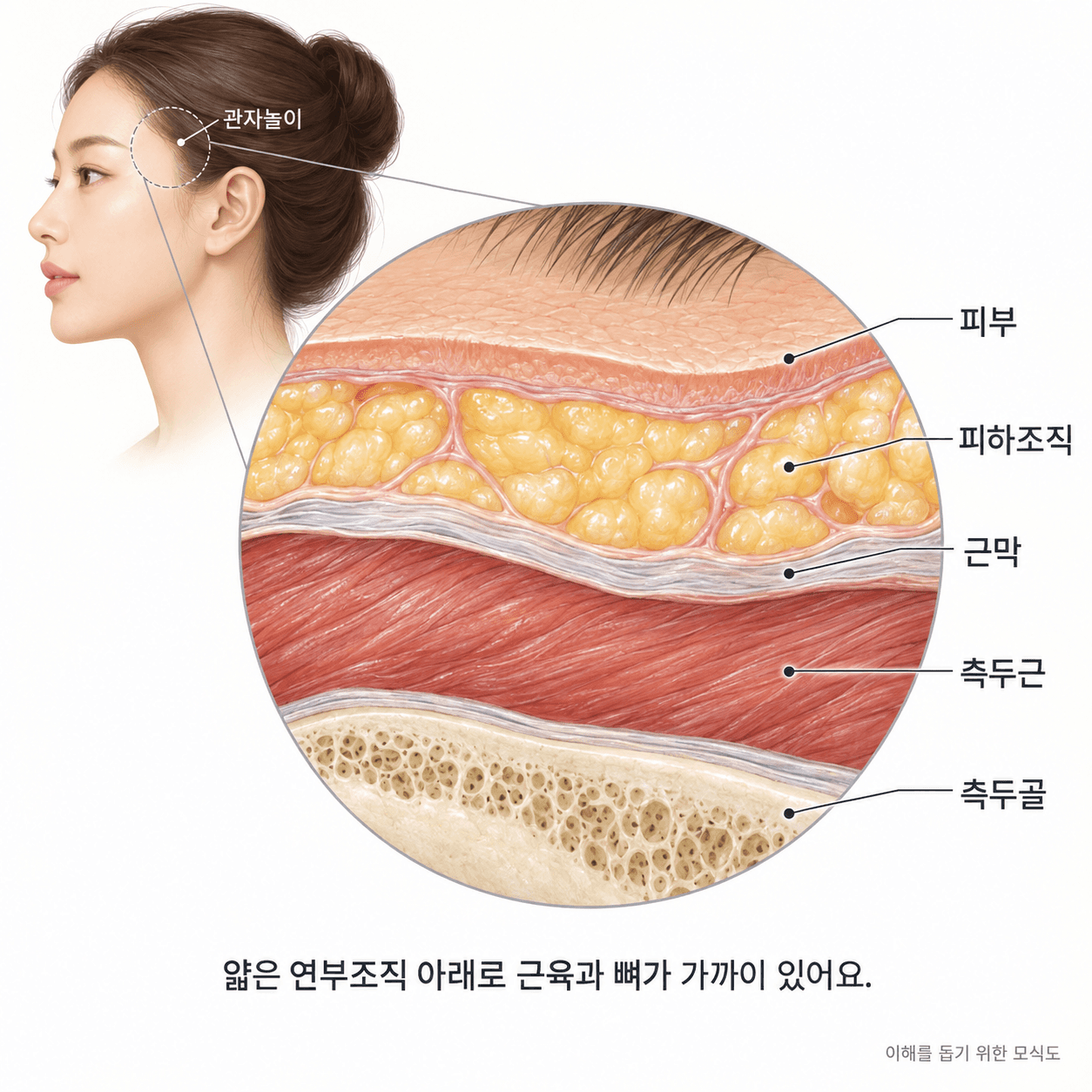 관자놀이 위치와 피부·피하조직·근막·측두근·측두골의 관계를 보여주는 모식도
