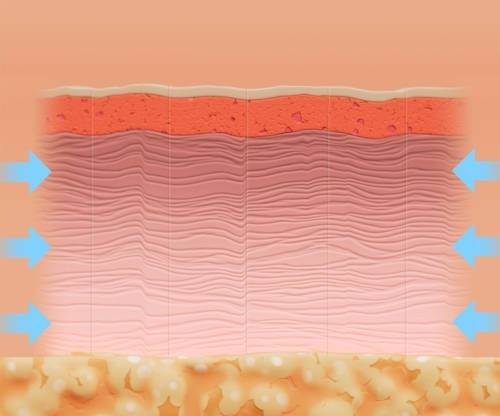 Ellacor Treatment