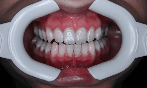 Cosmetic Bonding