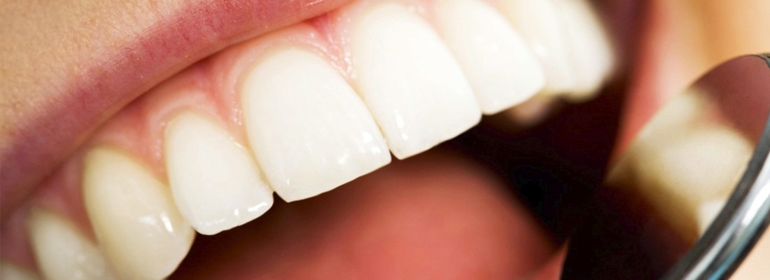 Een mooi recht gebit