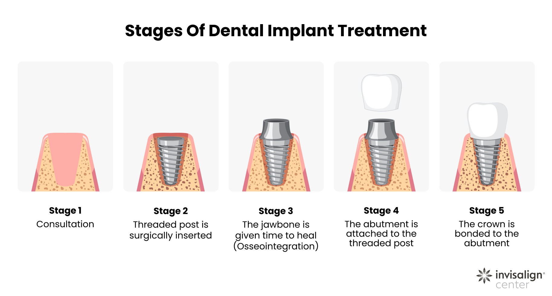 what to expect in terms of steps from the dental implant surgery with our specialists at the invisalign center in dubai