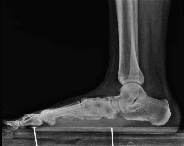 x-ray of Flat Feet Symptoms & Treatment