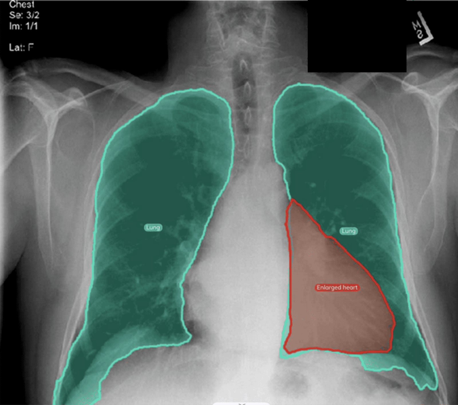 Example of organ detection in chest X-ray detection. Screenshot from v7.