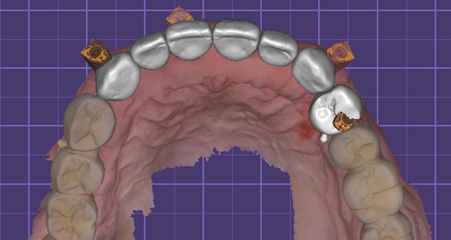 상.하악 13개 디자인 완성
