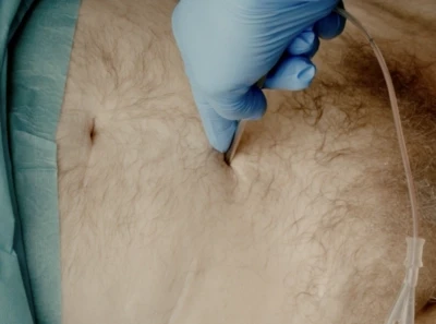 Suprepubic catherer placement