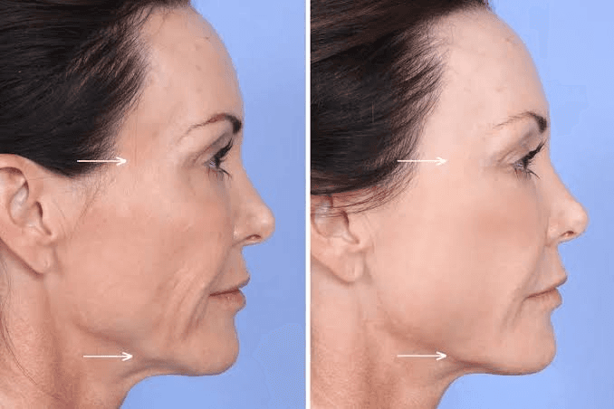 How Does Sculptra Stimulate Collagen