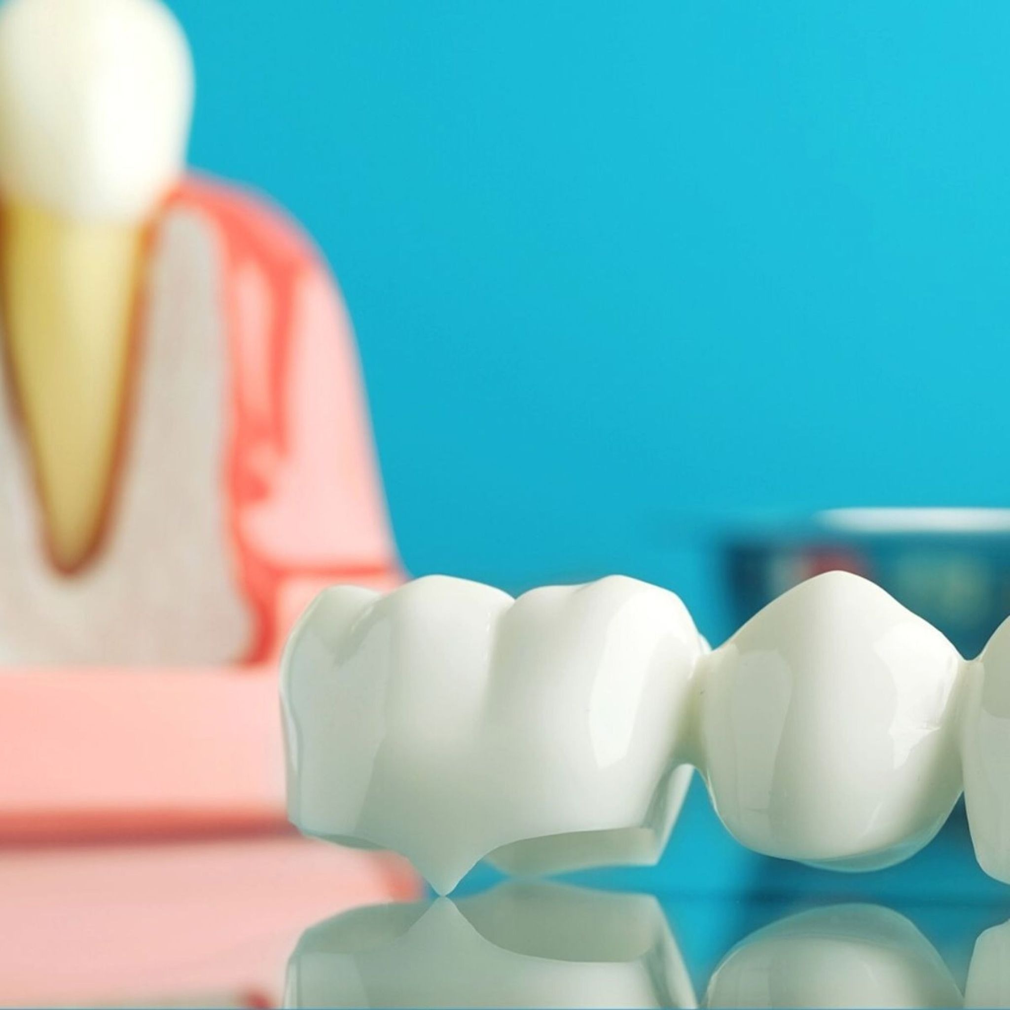 Dental Bridges for tooth restoration