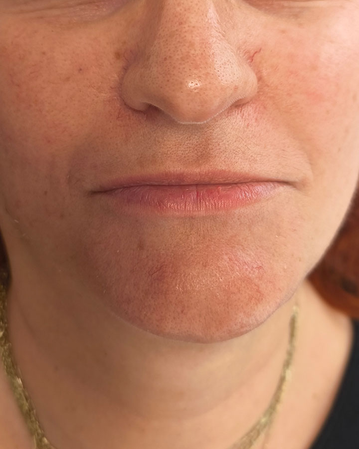 Nevýrazná kontúra hornej pery v zrelom veku pred omladením