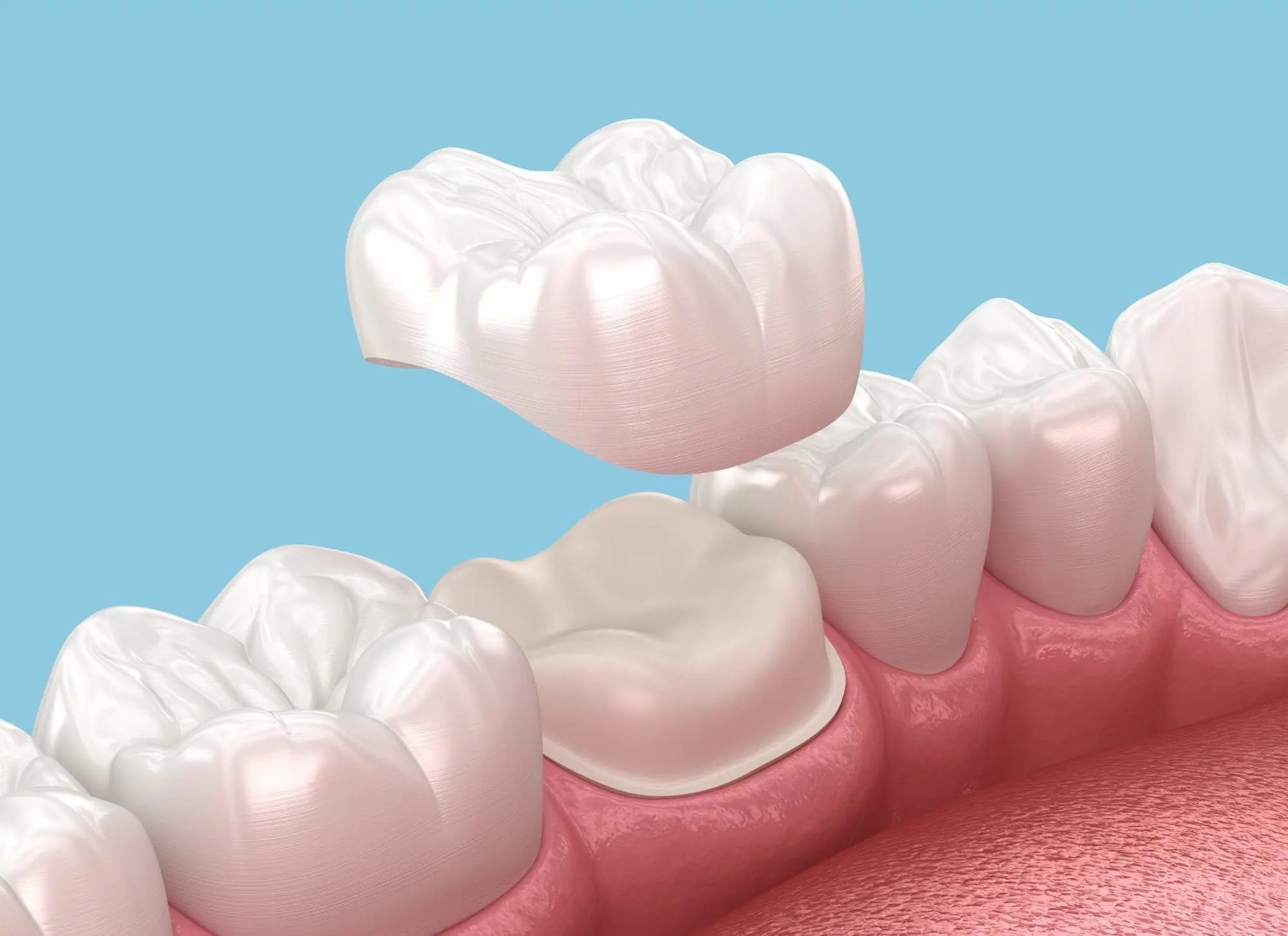dental crowns