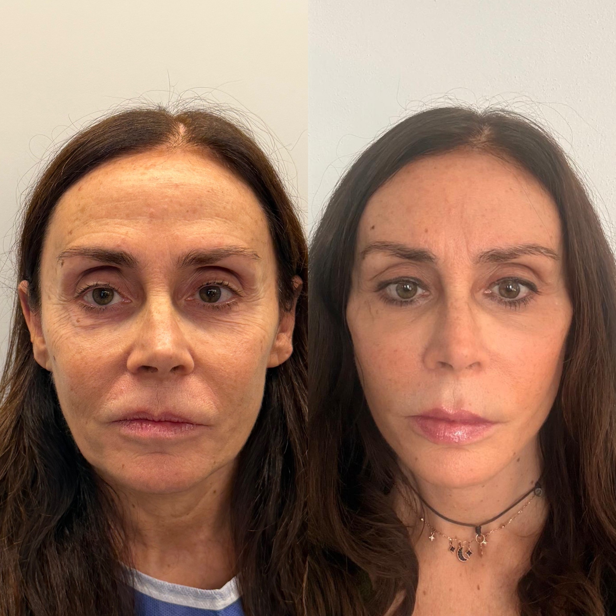 deep plane face and neck lift nano fat inhection co2 laser before after front view
