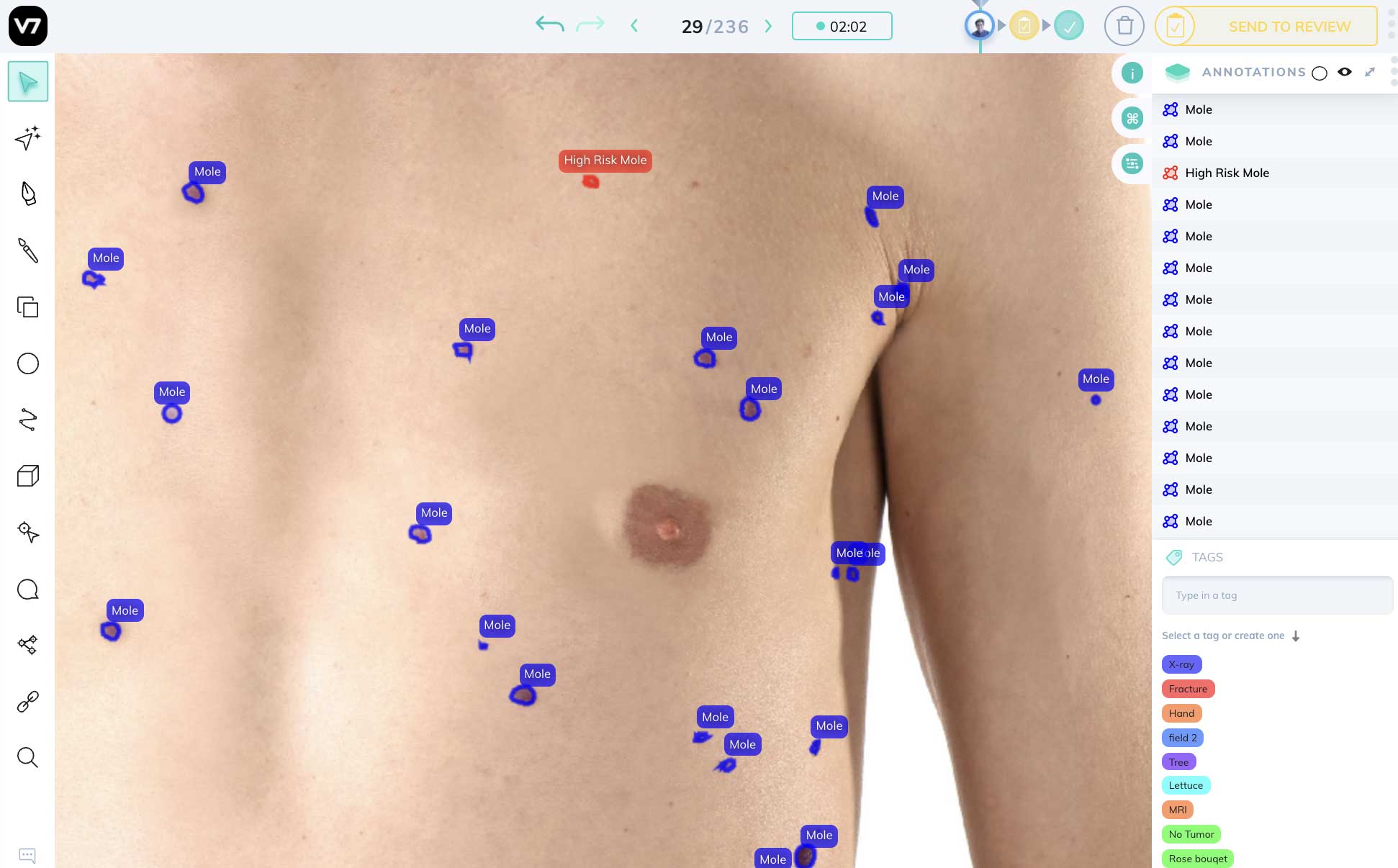 Melanoma detection ai computer vision annotation