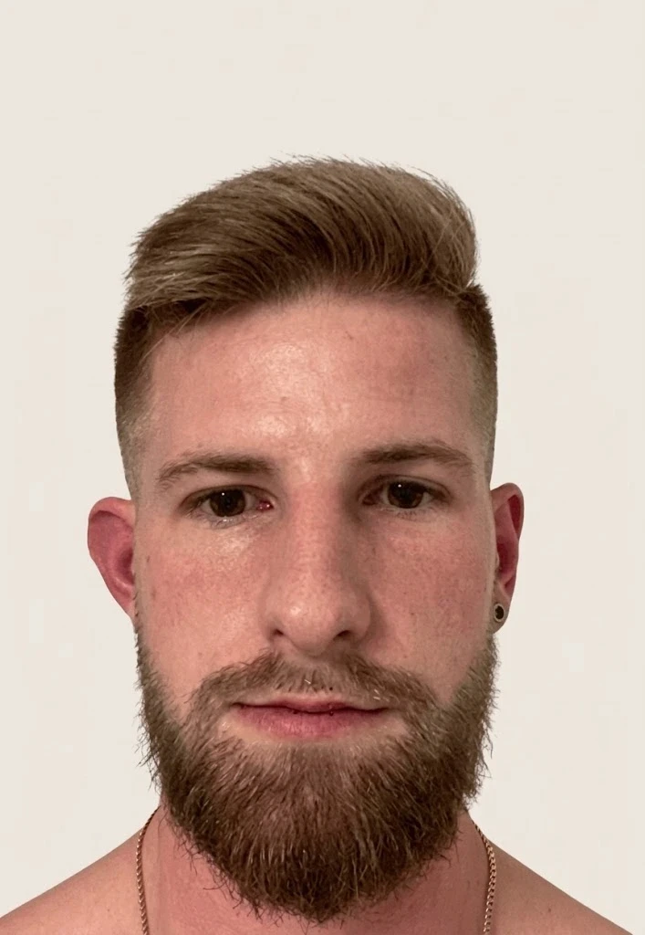 Naturally dense result after autologous hair beard transplantation in the Istanbul partner clinic