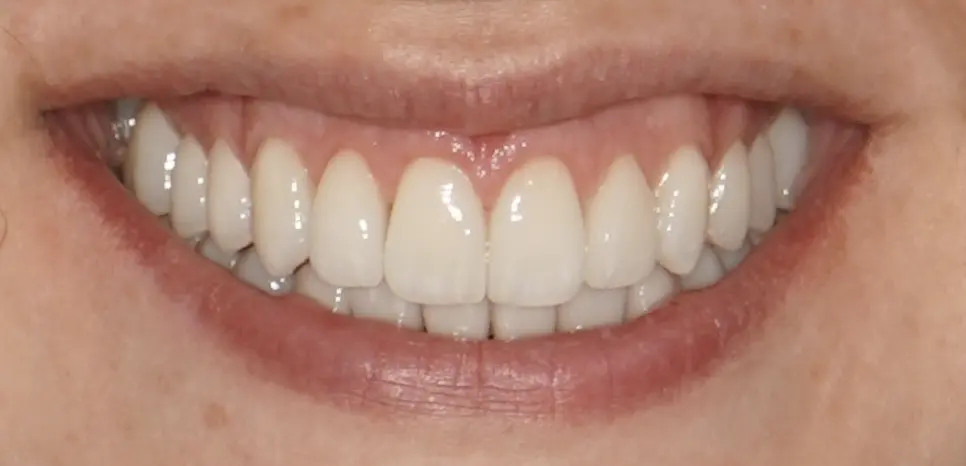 After prosthetic rehabilitation