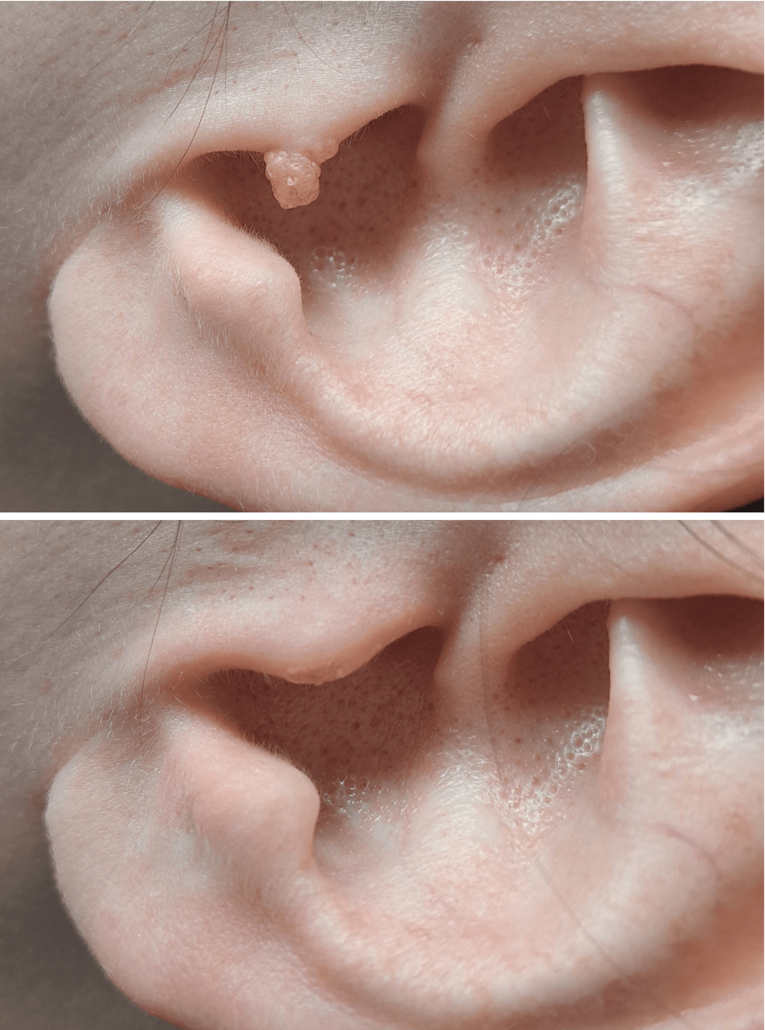 Skin tag removal before and after on ear