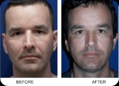Before and after of surgery image