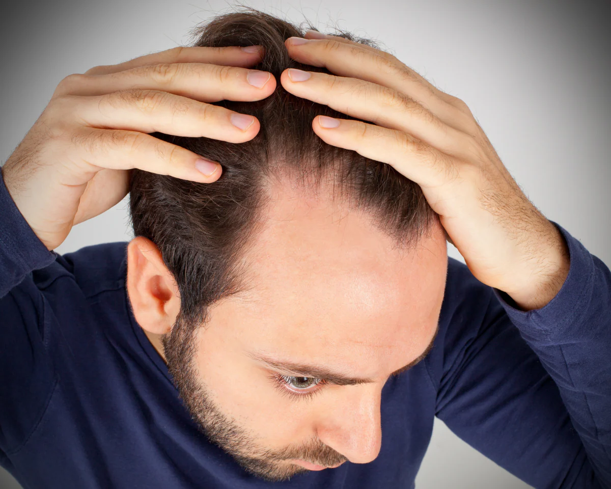 Is Tirzepatide Hair Loss Permanent