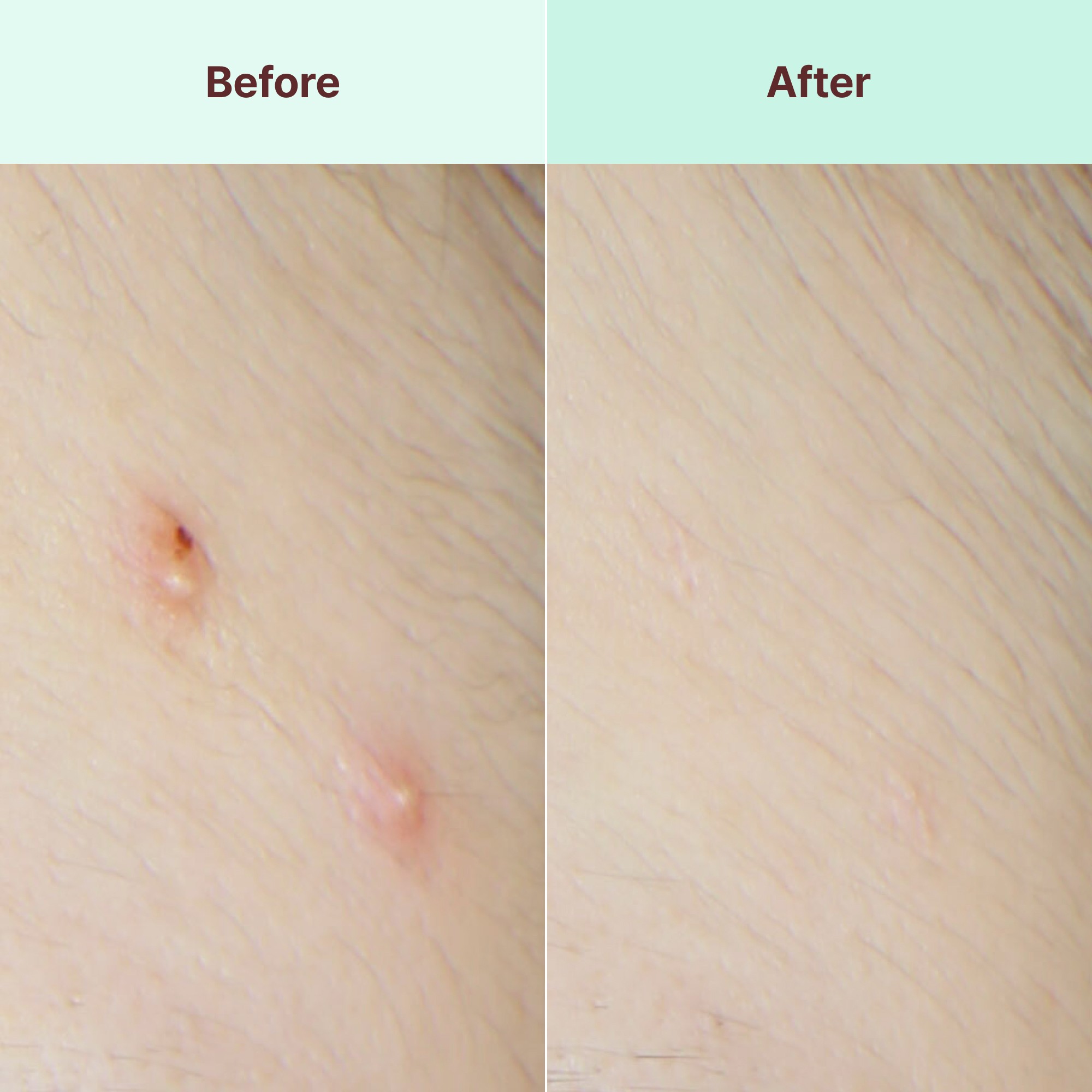 1-Week Visible Blemish Reduction and Skin Improvement Data