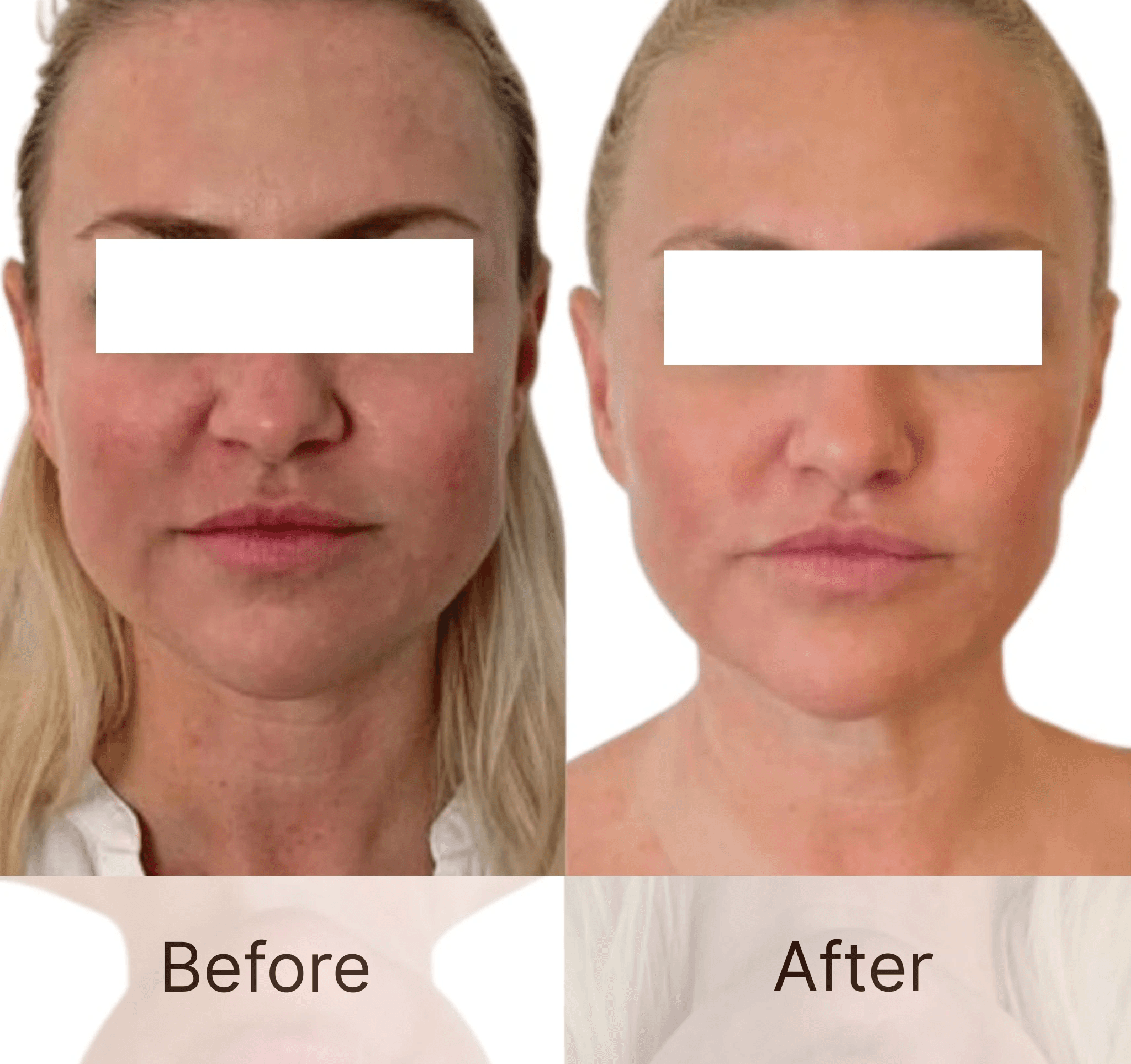 Poly(L-lactic Acid) Injectable Facial Filler Microspheres Factory