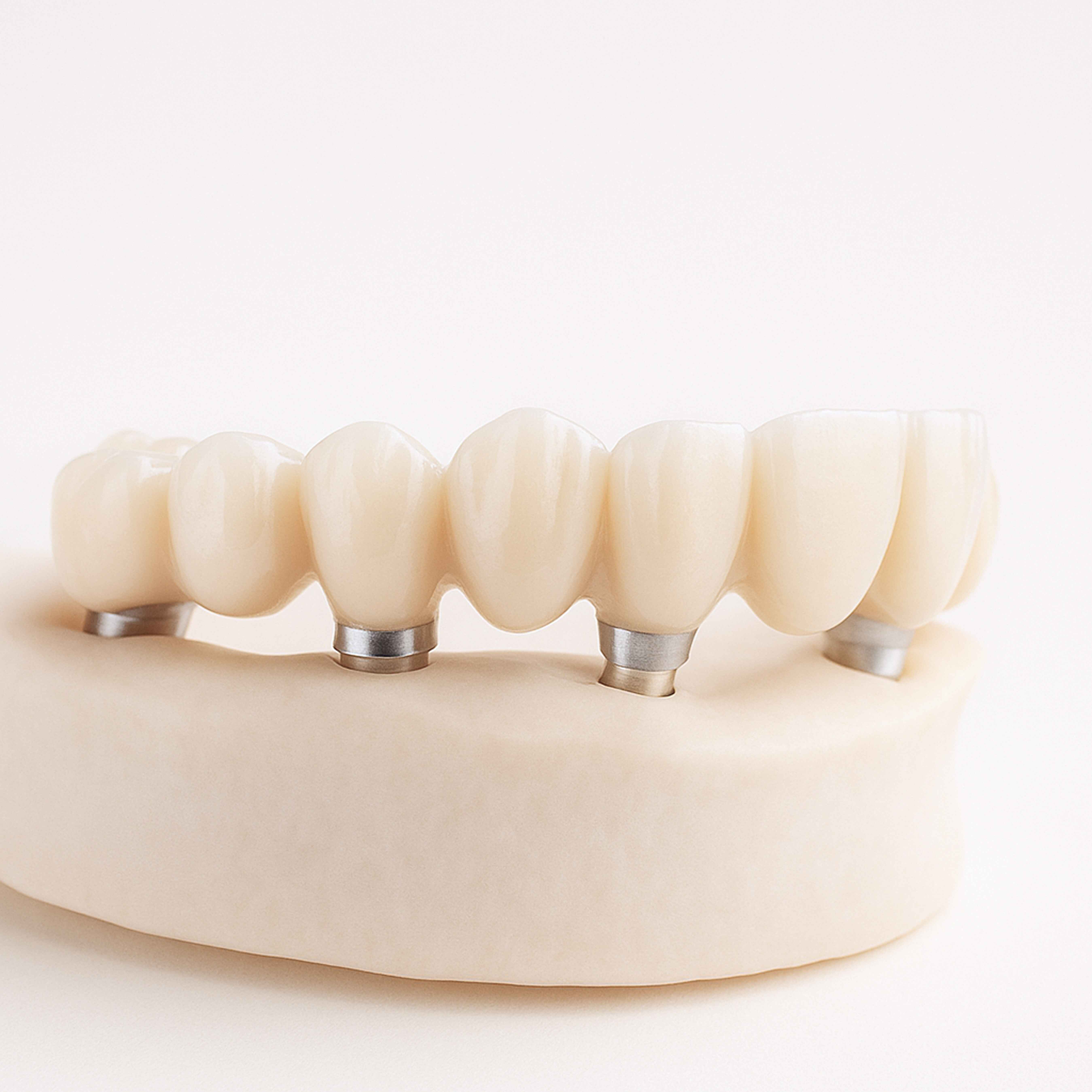 Žandikaulio rekonstrukcija implantais – visos dantų eilės atkūrimas ant implantų