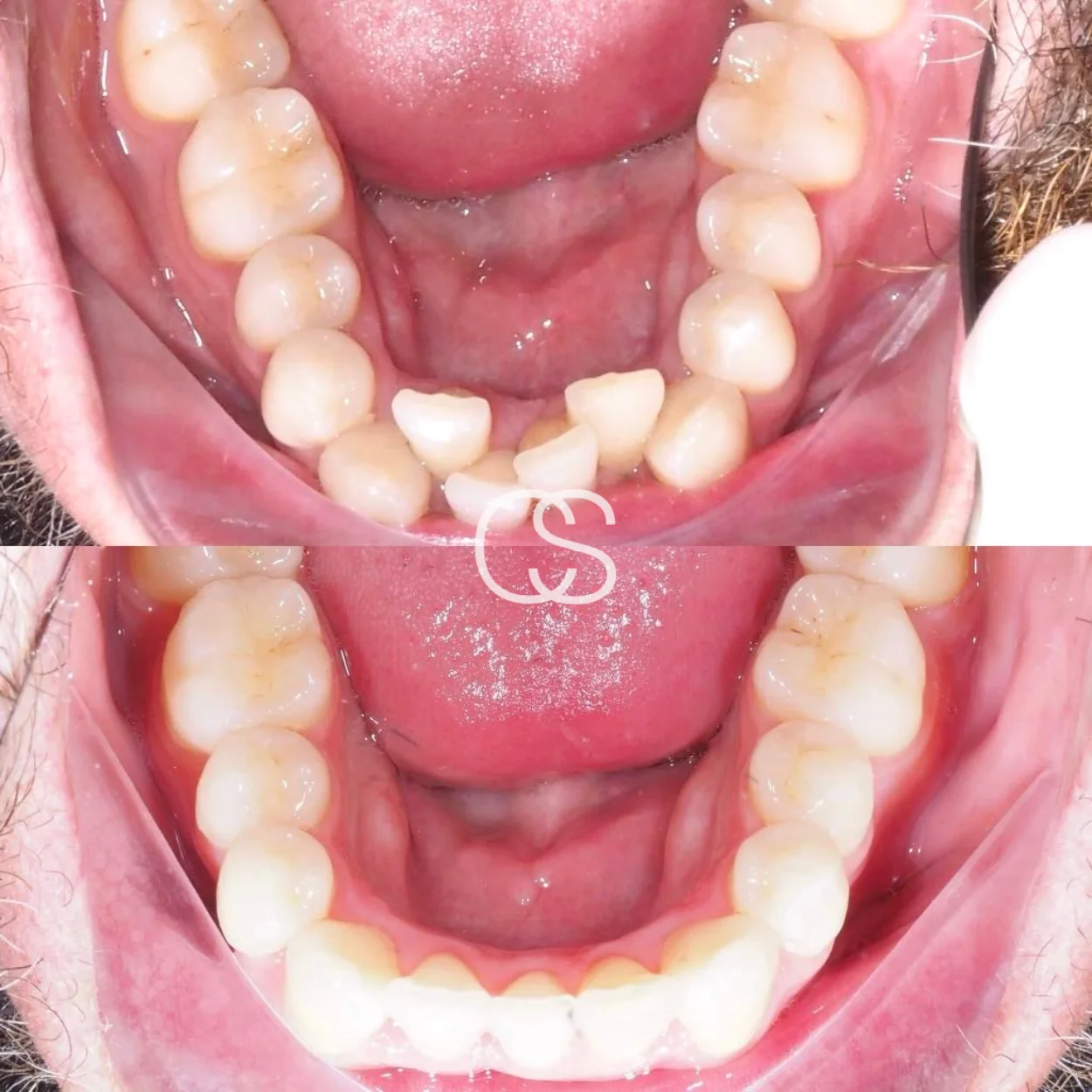Before & After Invisalign at Colac Smiles, Colac