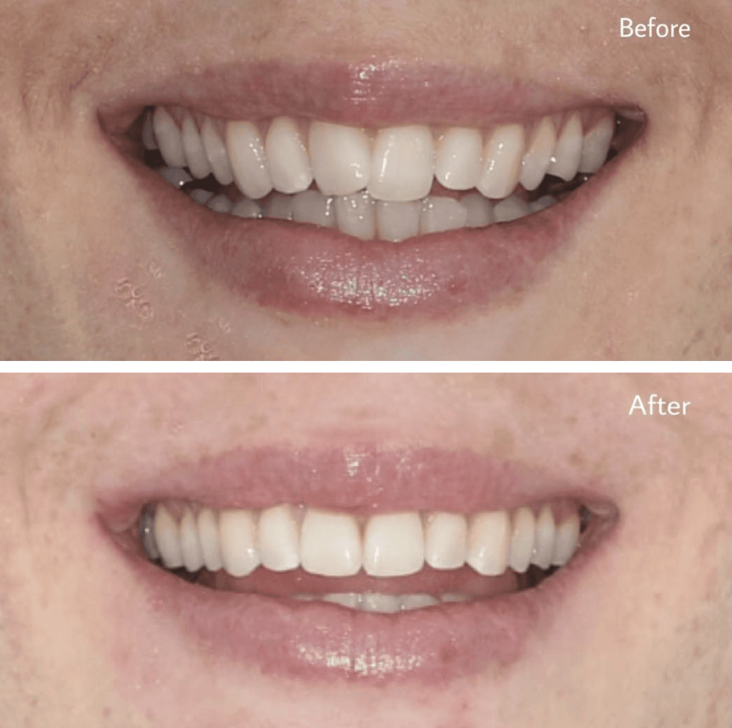 Invisalign® before and after featuring a transformation from misaligned to perfectly aligned teeth at Invisalign Center in Dubai.