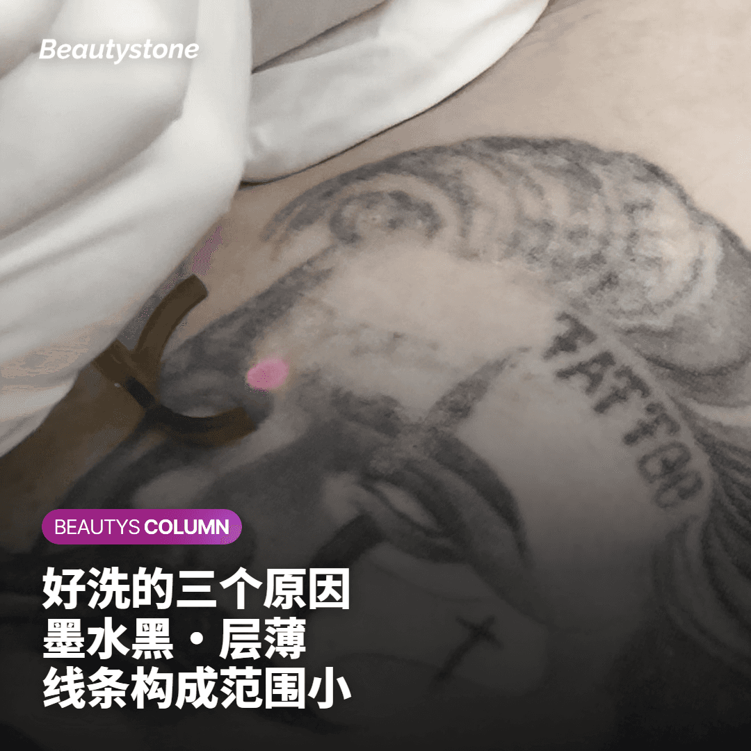 字母纹身激光去除前后黑色墨水反应