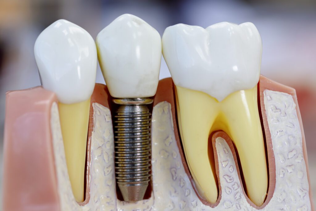 single dental implant