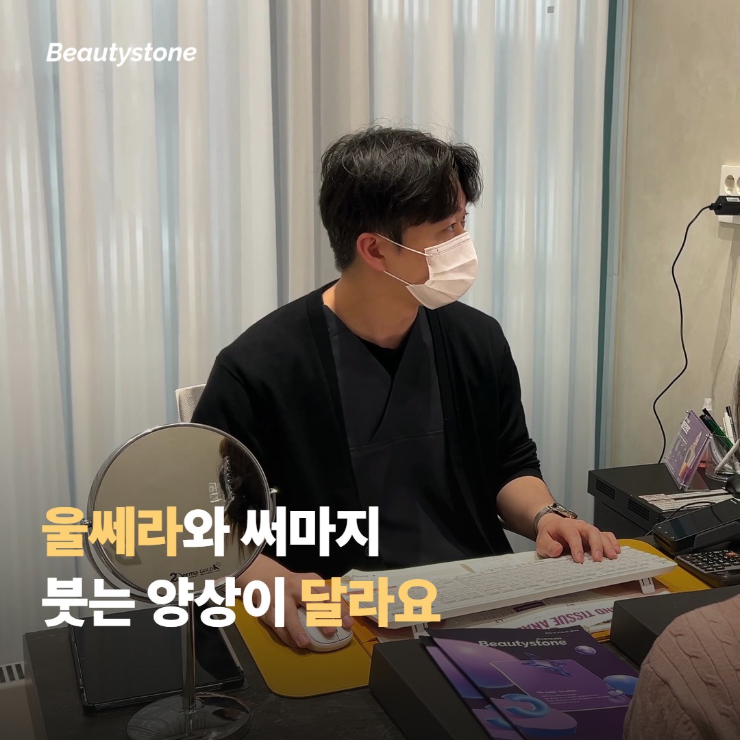 울쎄라와 써마지, 붓는 양상이 조금 달라요