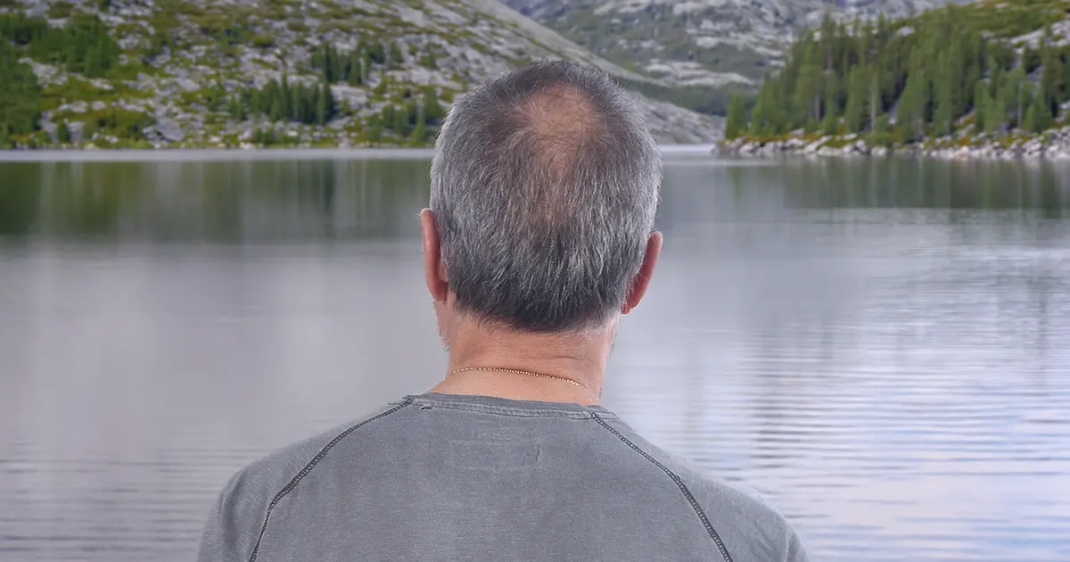 Illustrasjonsbilde av en mann som får tilbake hårveksten.