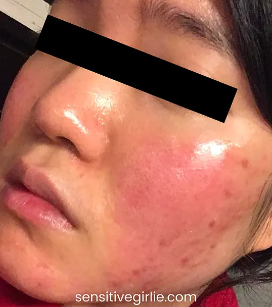 หน้าแพ้สารสเตียรอยด์