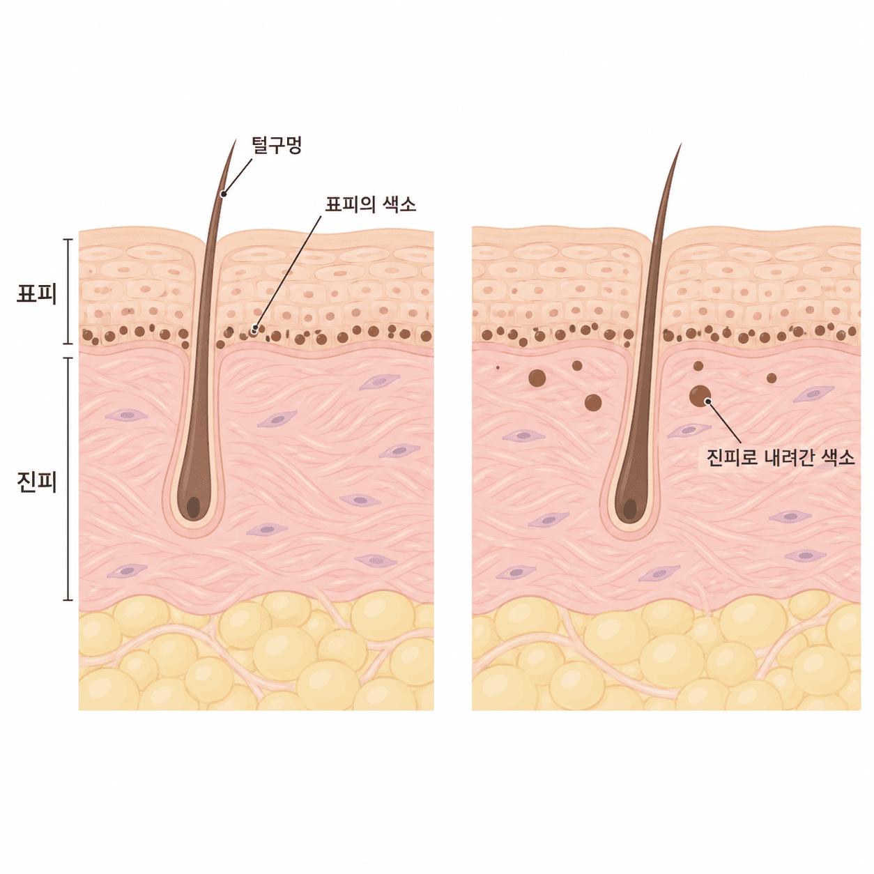 표피에 머문 색은 비교적 빨리 옅어지고, 진피로 내려간 색은 훨씬 오래 남아요.